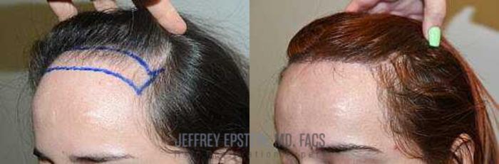 Before & After Hairline Lowering / Forehead Reduction Case 250 View 3 View in Miami, FL