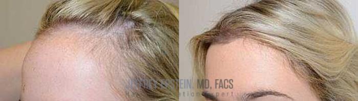 Before & After Hairline Lowering / Forehead Reduction Case 251 View 1 View in Miami, FL