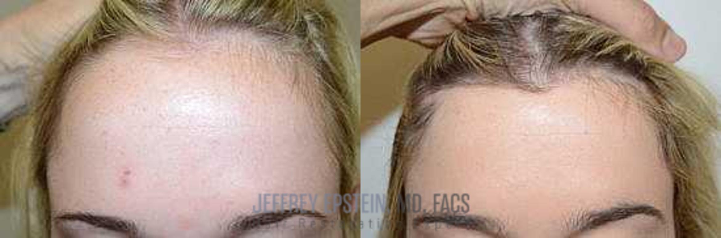 Before & After Hairline Lowering / Forehead Reduction Case 251 View 2 View in Miami, FL