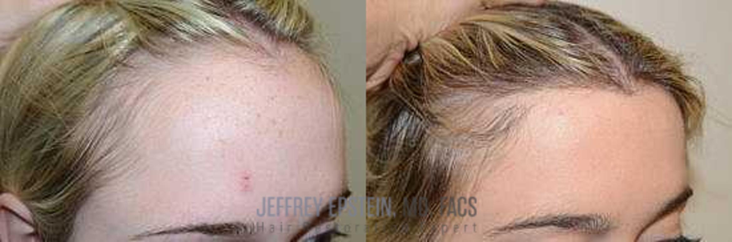 Before & After Hairline Lowering / Forehead Reduction Case 251 View 3 View in Miami, FL
