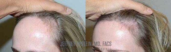 Before & After Hairline Lowering / Forehead Reduction Case 252 View 1 View in Miami, FL