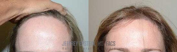 Before & After Hairline Lowering / Forehead Reduction Case 252 View 2 View in Miami, FL