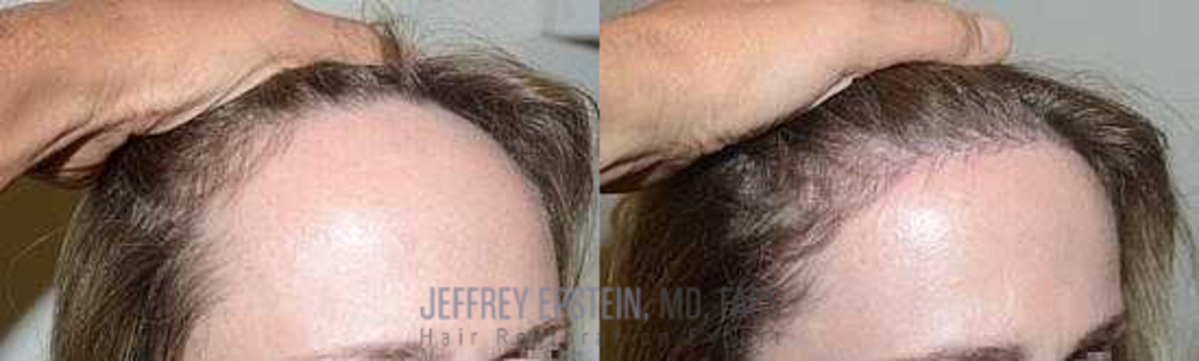 Before & After Hairline Lowering / Forehead Reduction Case 252 View 3 View in Miami, FL