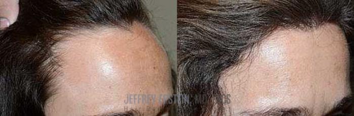 Before & After Hairline Lowering / Forehead Reduction Case 254 View 1 View in Miami, FL