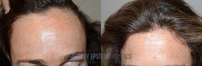Before & After Hairline Lowering / Forehead Reduction Case 254 View 2 View in Miami, FL