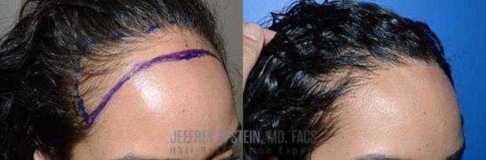 Before & After Hairline Lowering / Forehead Reduction Case 255 View 2 View in Miami, FL