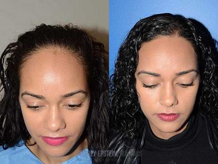 Before & After Hairline Lowering / Forehead Reduction Case 255 View 3 View in Miami, FL