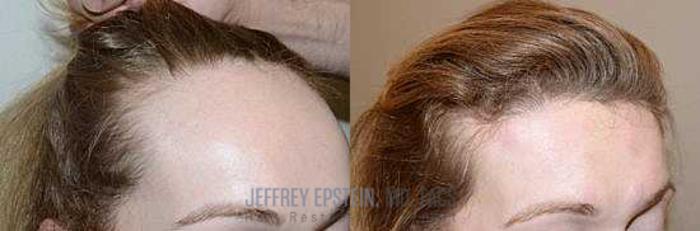 Before & After Hairline Lowering / Forehead Reduction Case 256 View 1 View in Miami, FL