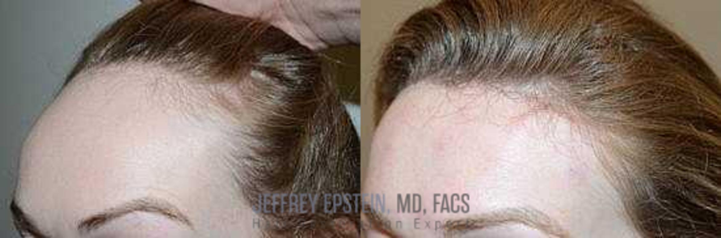 Before & After Hairline Lowering / Forehead Reduction Case 256 View 2 View in Miami, FL