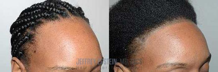 Before & After Hairline Lowering / Forehead Reduction Case 257 View 1 View in Miami, FL