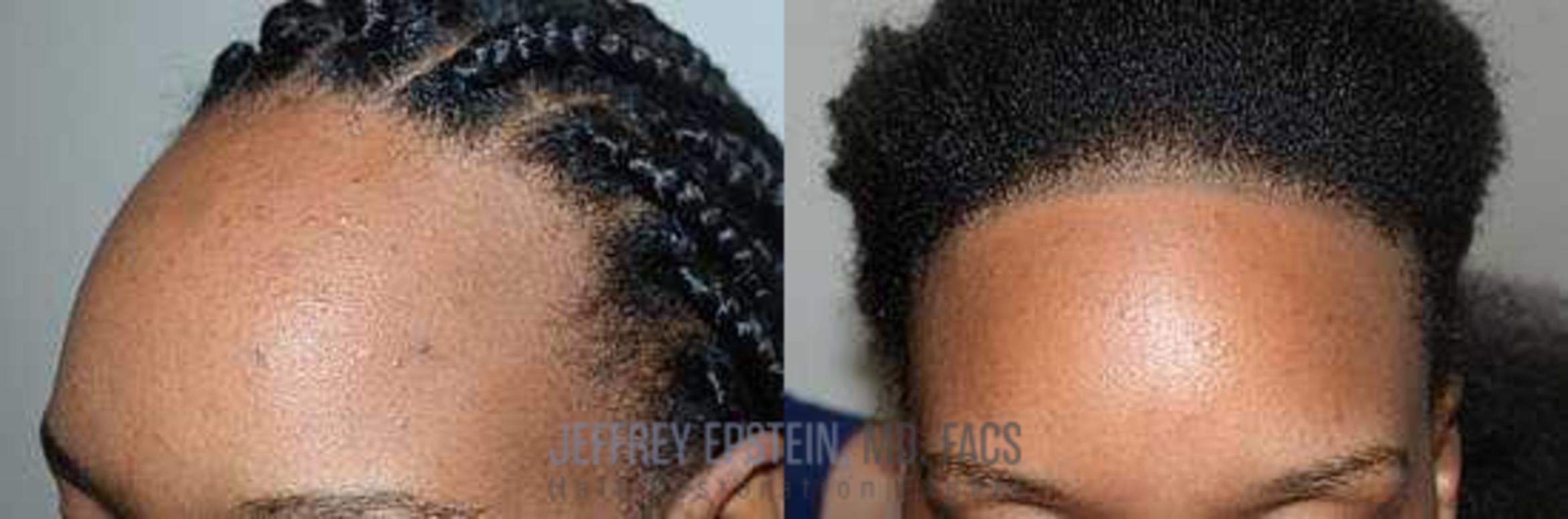 Before & After Hairline Lowering / Forehead Reduction Case 257 View 3 View in Miami, FL
