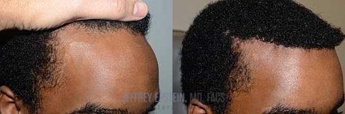 Before & After Hairline Lowering / Forehead Reduction Case 258 View 2 View in Miami, FL