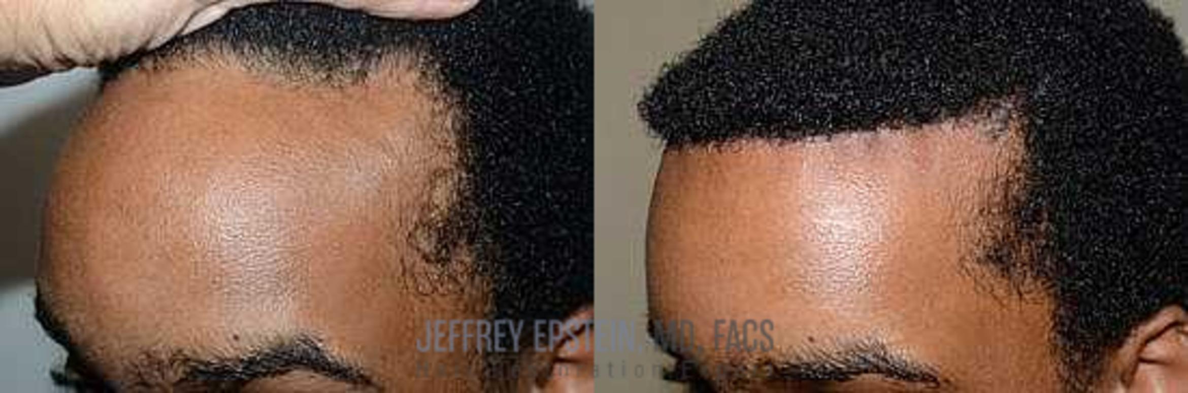 Before & After Hairline Lowering / Forehead Reduction Case 258 View 3 View in Miami, FL
