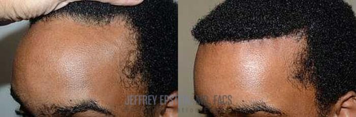 Before & After Hairline Lowering / Forehead Reduction Case 258 View 3 View in Miami, FL