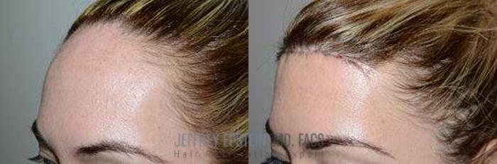 Before & After Hairline Lowering / Forehead Reduction Case 259 View 1 View in Miami, FL