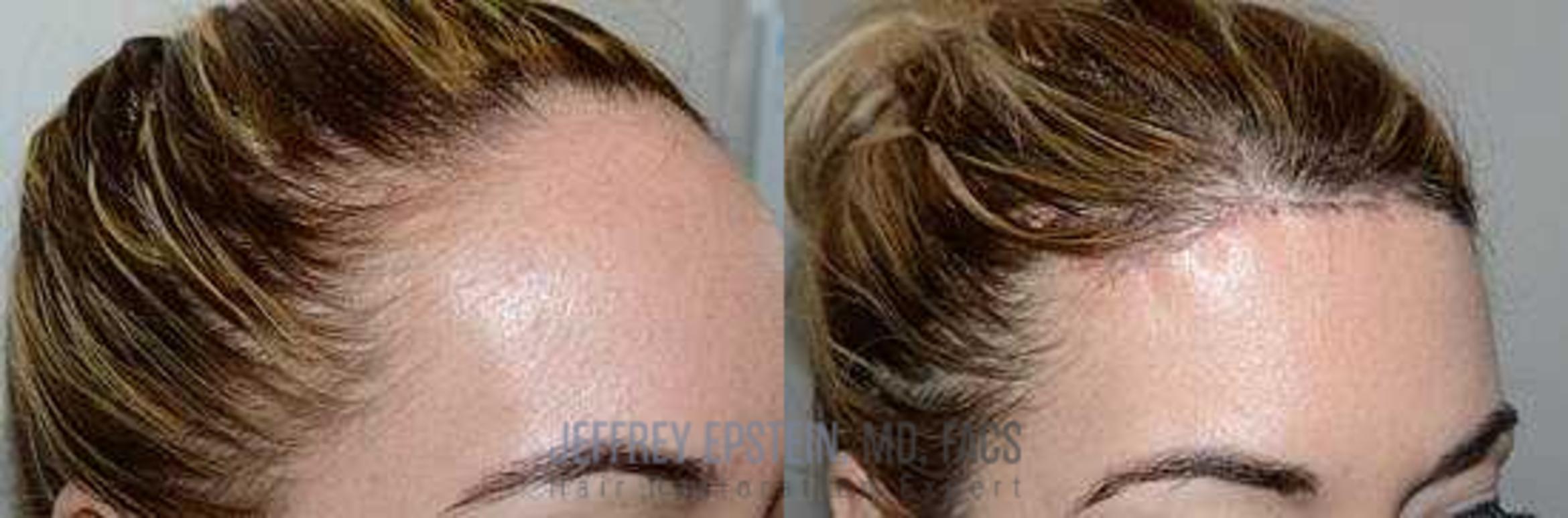 Before & After Hairline Lowering / Forehead Reduction Case 259 View 2 View in Miami, FL