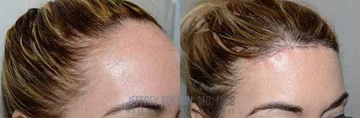 Before & After Hairline Lowering / Forehead Reduction Case 259 View 2 View in Miami, FL