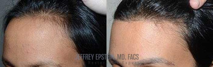 Before & After Hairline Lowering / Forehead Reduction Case 260 View 1 View in Miami, FL