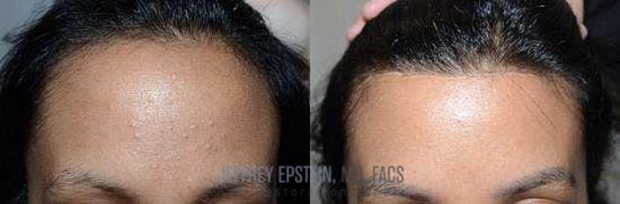 Before & After Hairline Lowering / Forehead Reduction Case 260 View 2 View in Miami, FL