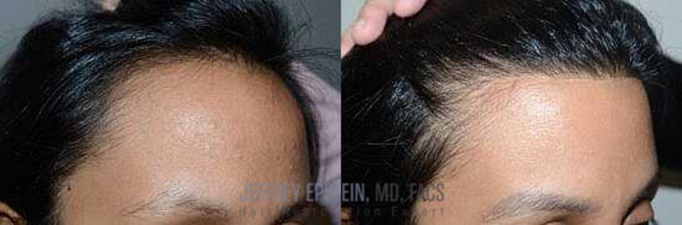 Before & After Hairline Lowering / Forehead Reduction Case 260 View 3 View in Miami, FL