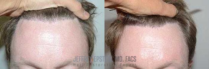 Before & After Hairline Lowering / Forehead Reduction Case 262 View 1 View in Miami, FL