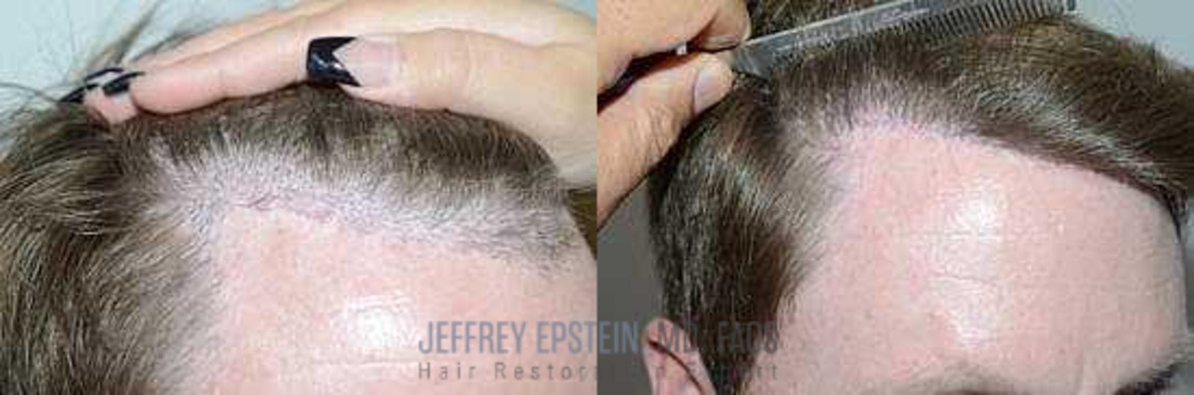 Before & After Hairline Lowering / Forehead Reduction Case 262 View 2 View in Miami, FL