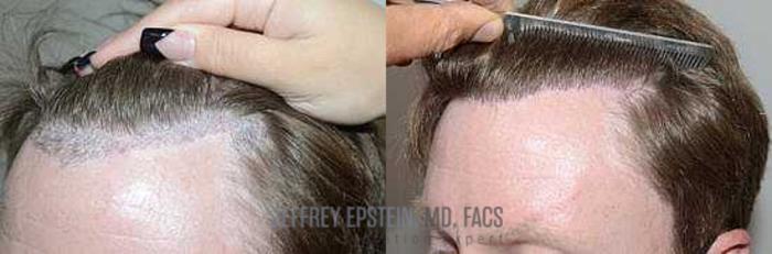 Before & After Hairline Lowering / Forehead Reduction Case 262 View 3 View in Miami, FL