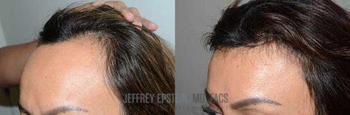 Before & After Hairline Lowering / Forehead Reduction Case 263 View 1 View in Miami, FL