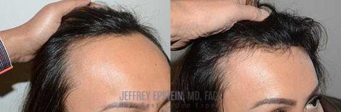 Before & After Hairline Lowering / Forehead Reduction Case 263 View 2 View in Miami, FL