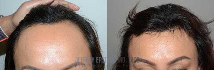 Before & After Hairline Lowering / Forehead Reduction Case 263 View 3 View in Miami, FL