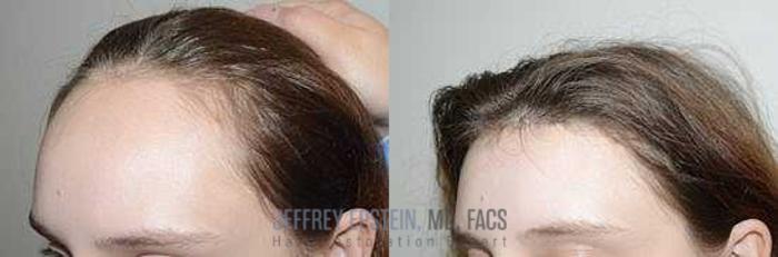 Before & After Hairline Lowering / Forehead Reduction Case 265 View 1 View in Miami, FL