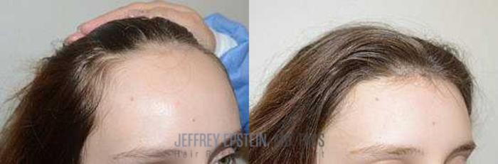 Before & After Hairline Lowering / Forehead Reduction Case 265 View 2 View in Miami, FL