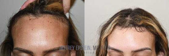 Before & After Hairline Lowering / Forehead Reduction Case 266 View 1 View in Miami, FL