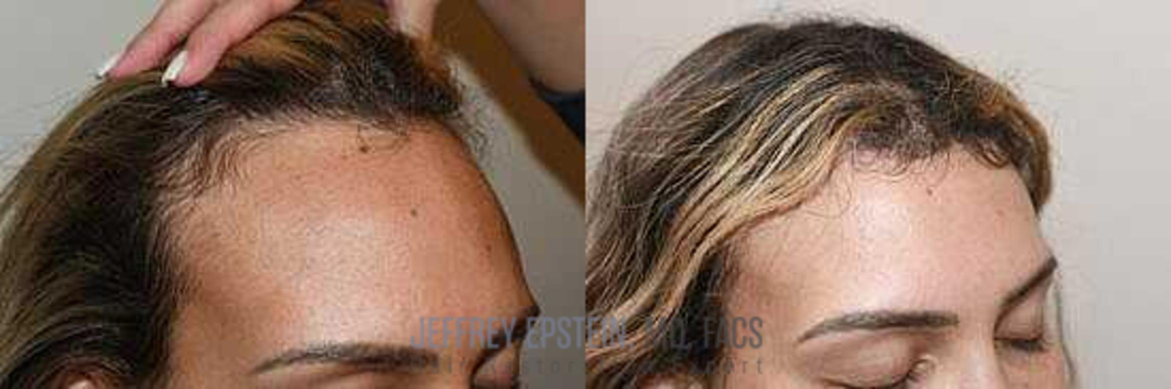 Before & After Hairline Lowering / Forehead Reduction Case 266 View 2 View in Miami, FL