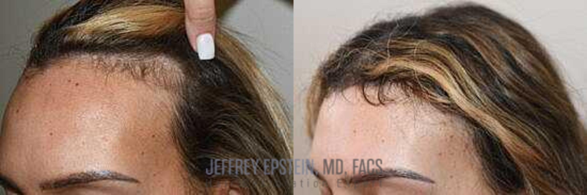 Before & After Hairline Lowering / Forehead Reduction Case 266 View 3 View in Miami, FL