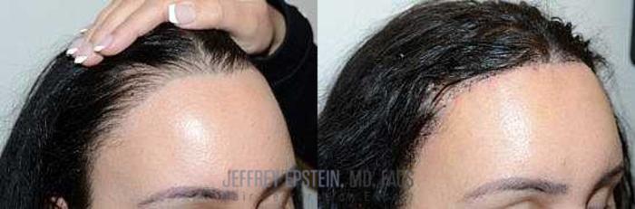 Before & After Hairline Lowering / Forehead Reduction Case 267 View 1 View in Miami, FL