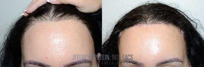 Before & After Hairline Lowering / Forehead Reduction Case 267 View 2 View in Miami, FL