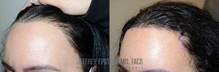 Before & After Hairline Lowering / Forehead Reduction Case 267 View 3 View in Miami, FL