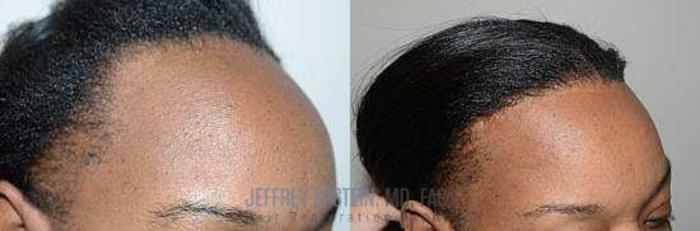 Before & After Hairline Lowering / Forehead Reduction Case 268 View 1 View in Miami, FL