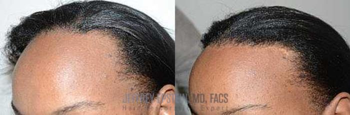 Before & After Hairline Lowering / Forehead Reduction Case 268 View 2 View in Miami, FL