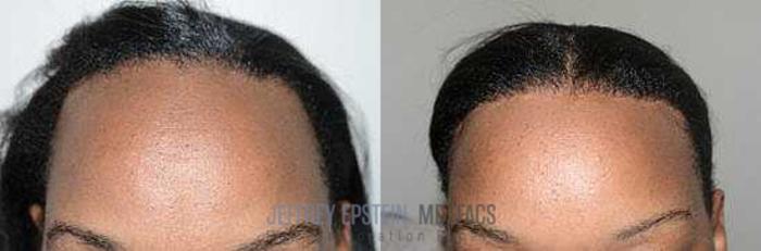 Before & After Hairline Lowering / Forehead Reduction Case 268 View 3 View in Miami, FL