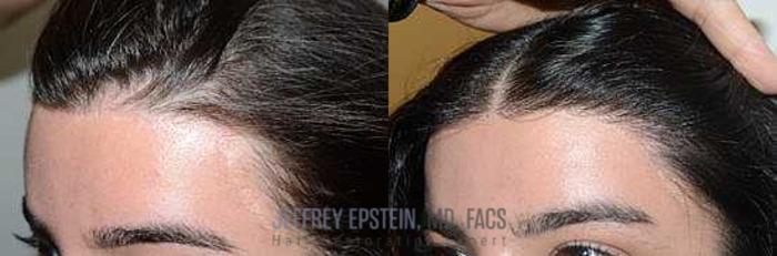 Before & After Hairline Lowering / Forehead Reduction Case 269 View 1 View in Miami, FL