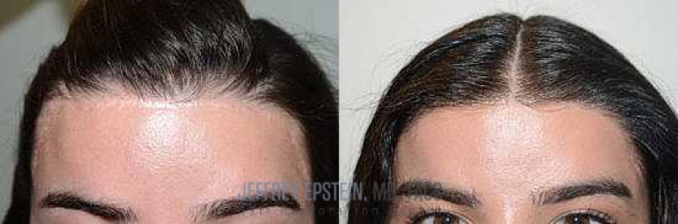 Before & After Hairline Lowering / Forehead Reduction Case 269 View 2 View in Miami, FL