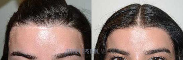 Before & After Hairline Lowering / Forehead Reduction Case 269 View 2 View in Miami, FL
