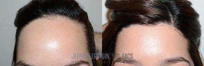 Before & After Hairline Lowering / Forehead Reduction Case 272 View 1 View in Miami, FL