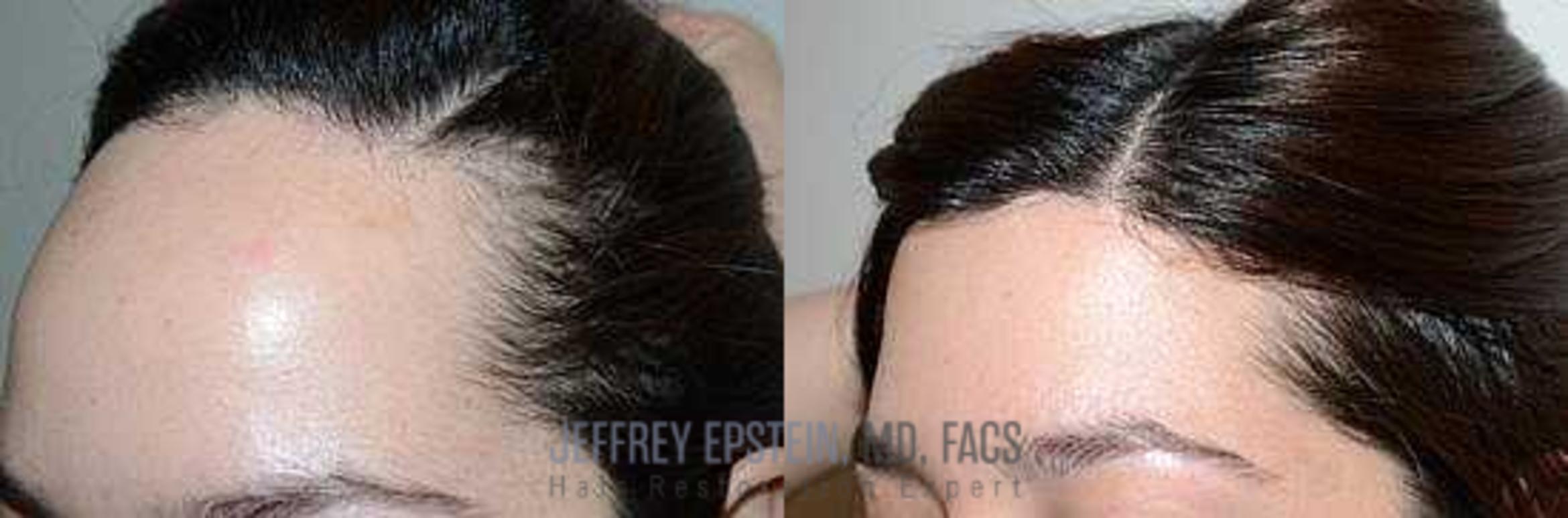 Before & After Hairline Lowering / Forehead Reduction Case 272 View 3 View in Miami, FL