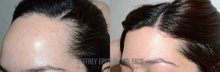 Before & After Hairline Lowering / Forehead Reduction Case 272 View 3 View in Miami, FL