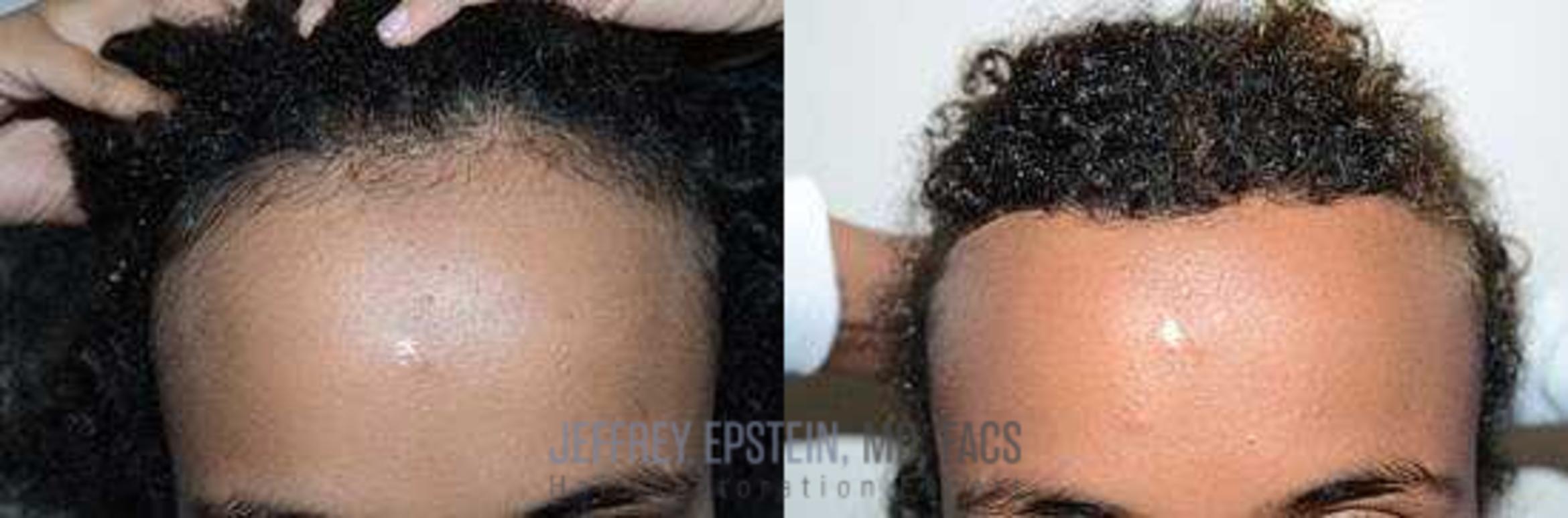 Before & After Hairline Lowering / Forehead Reduction Case 273 View 1 View in Miami, FL