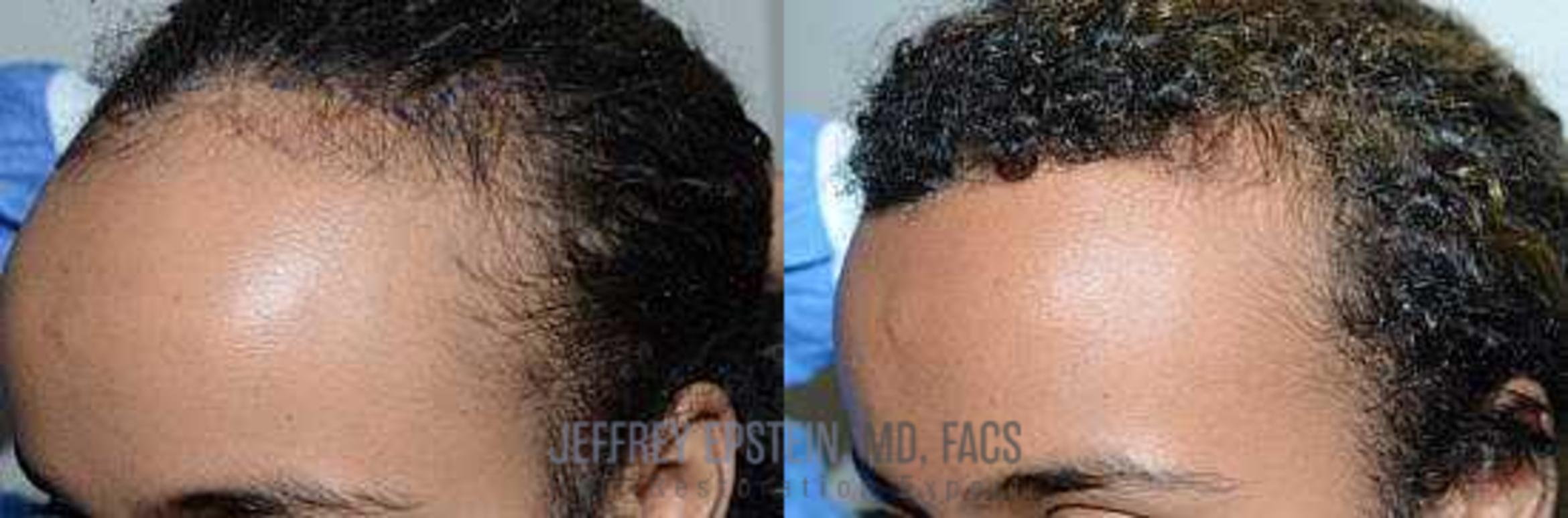 Before & After Hairline Lowering / Forehead Reduction Case 273 View 2 View in Miami, FL