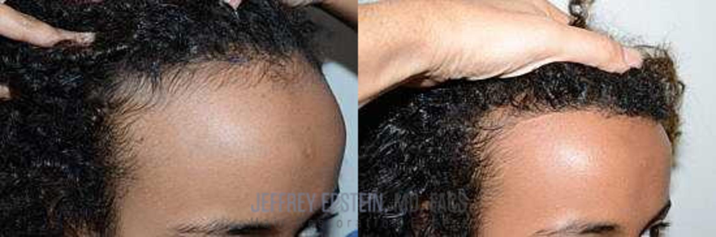 Before & After Hairline Lowering / Forehead Reduction Case 273 View 3 View in Miami, FL